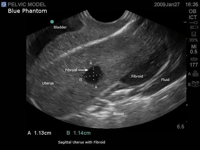 BluePhantom transvaginal ultraljudsträningsmodell för generell patologi