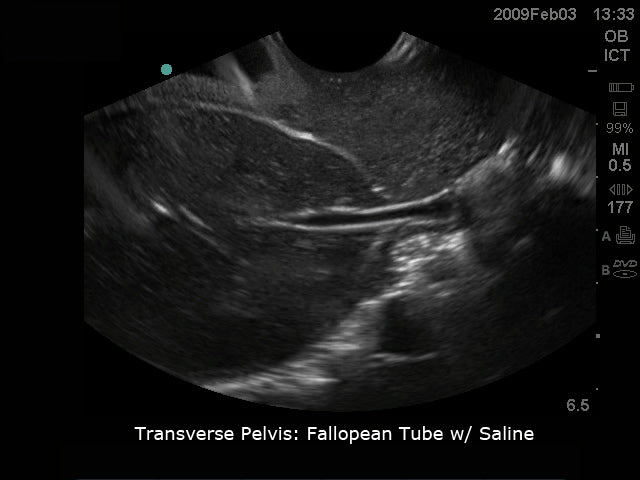 BluePhantom transvaginal ultralydstræningsmodel til sonohysterografi og sonosalpingografi