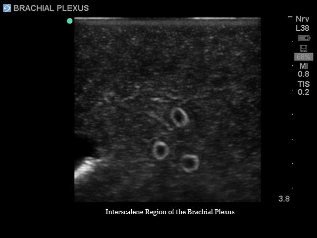 Blue Phantom Plexus brachialis-blockad samt ultraljudsvägledd CVK-inläggning med insättning av ersättningsvävnad