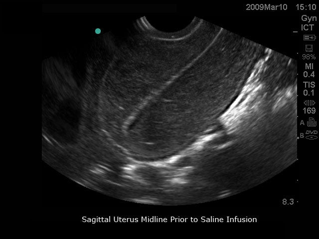 BluePhantom transvaginal ultralydstræningsmodel til sonohysterografi og sonosalpingografi