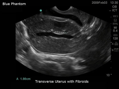 BluePhantom transvaginal ultralydstræningsmodel til sonohysterografi og sonosalpingografi