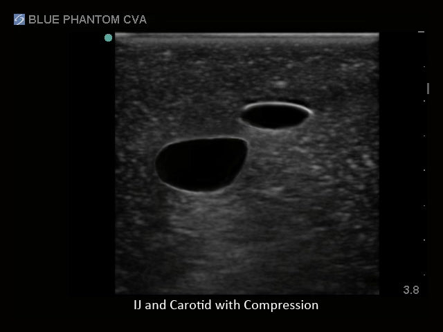 Blue Phantom Ultrasound Central Line Model with Transparent Insert