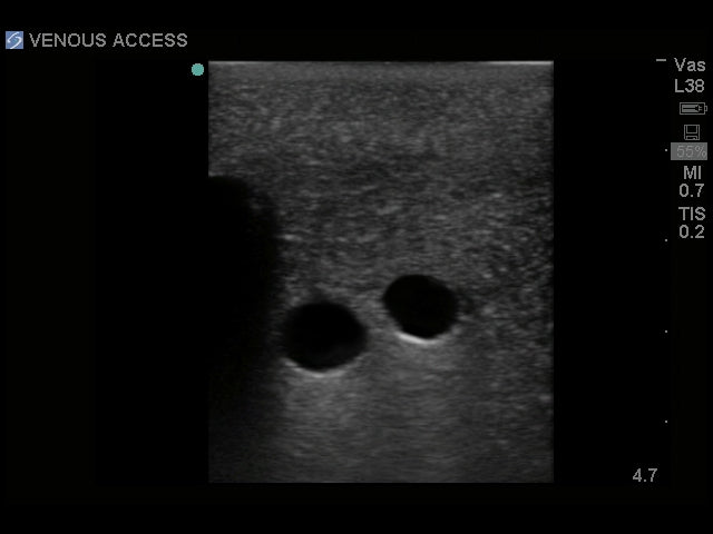 Blue Phantom Ultrasound Central Line Model with Transparent Insert