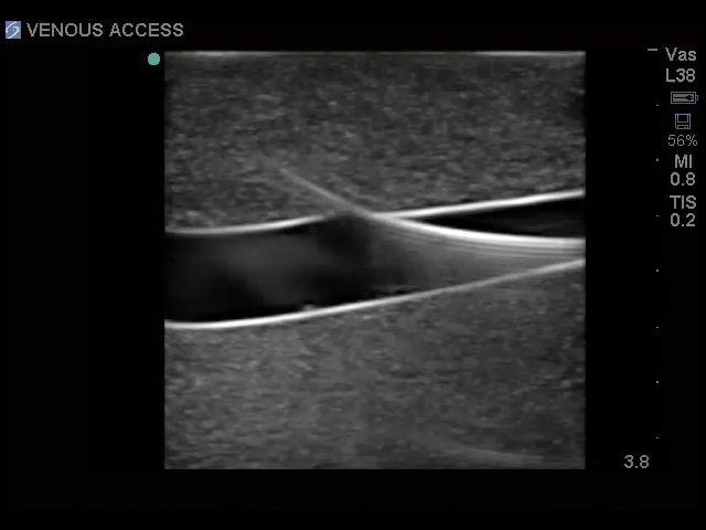 Blue Phantom Ultrasound Central Line Model with Transparent Insert