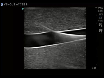 Blue Phantom Ultrasound Central Line Model with Transparent Insert