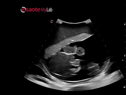 Blue Phantom Ultrasound Training Model Percutaneous Umbilical Cord Blood Sampling