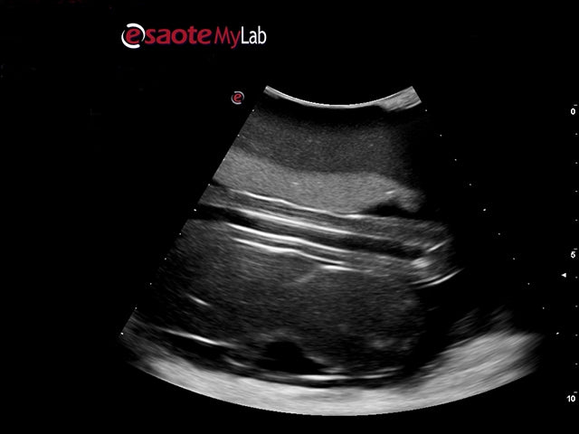 Blue Phantom Ultrasound Training Model Percutaneous Umbilical Cord Blood Sampling