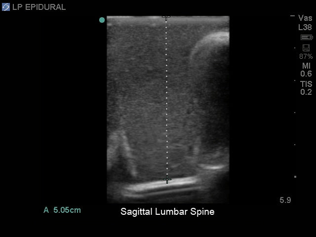 Blue Phantom Lumbar Puncture and Spinal Epidural