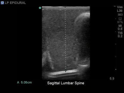 Blue Phantom Lumbar Puncture and Spinal Epidural