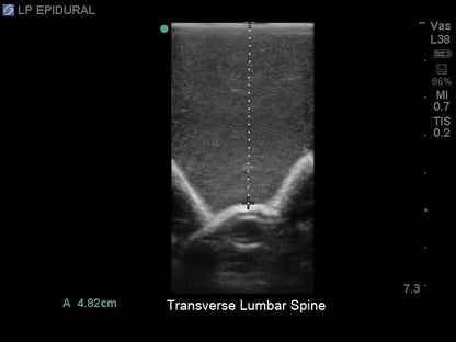 Blue Phantom Lumbar Puncture and Spinal Epidural