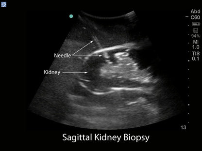 Blue Phantom Ultralydstrænings Model Renal Biopsi