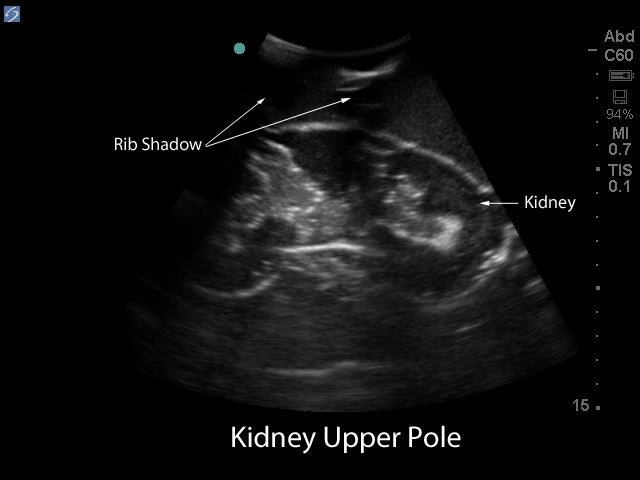 Blue Phantom Ultralydstrænings Model Renal Biopsi