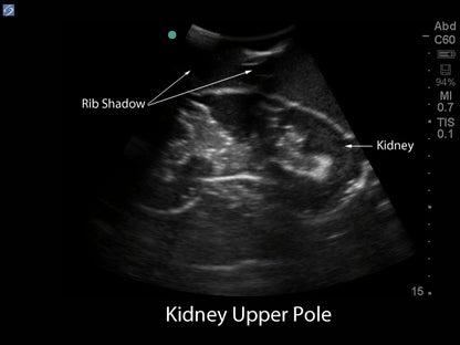 Blue Phantom Ultralydstrænings Model Renal Biopsi