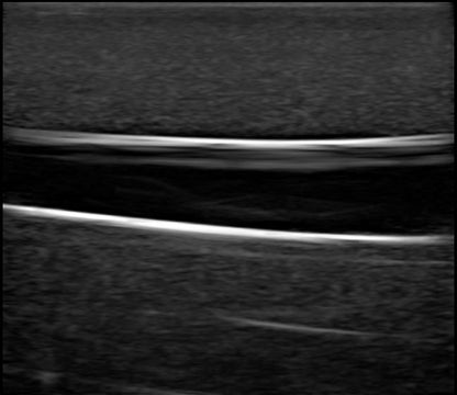 BluePhantom PICC Ultraljudsträningsarm med IV & Arteriell Vaskulär Åtkomst