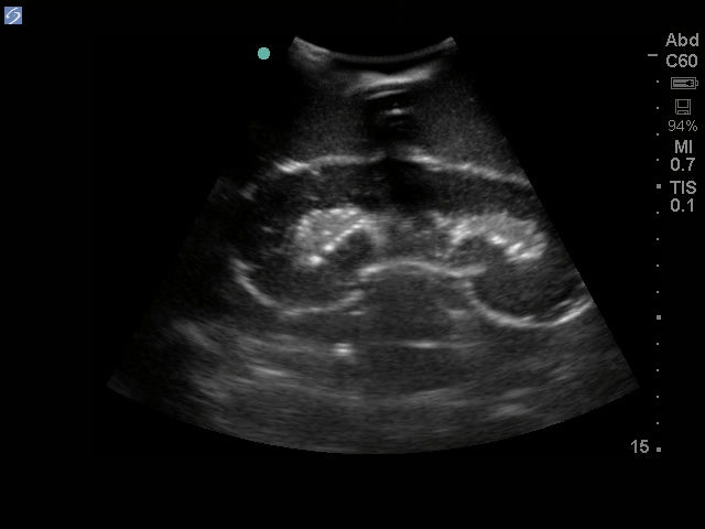 Blue Phantom Ultralydstrænings Model Renal Biopsi
