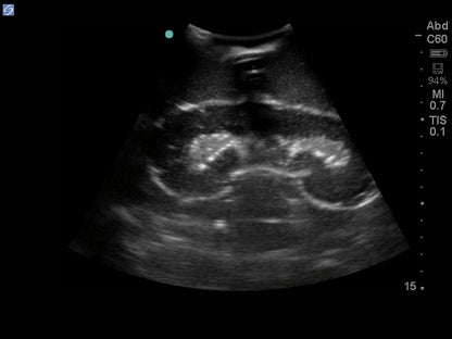 Blue Phantom Ultralydstrænings Model Renal Biopsi